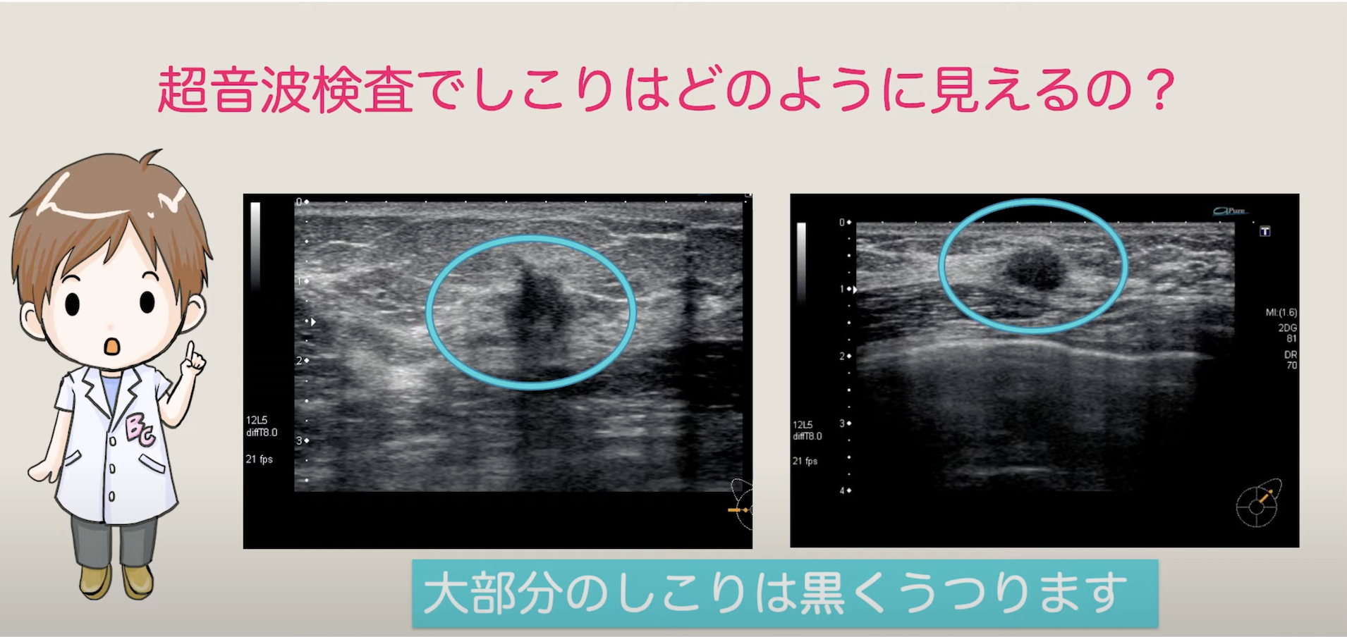 乳癌 マンモグラフィー 画像の見方 : マンモグラフィ検診結果の見方 – SBECQ