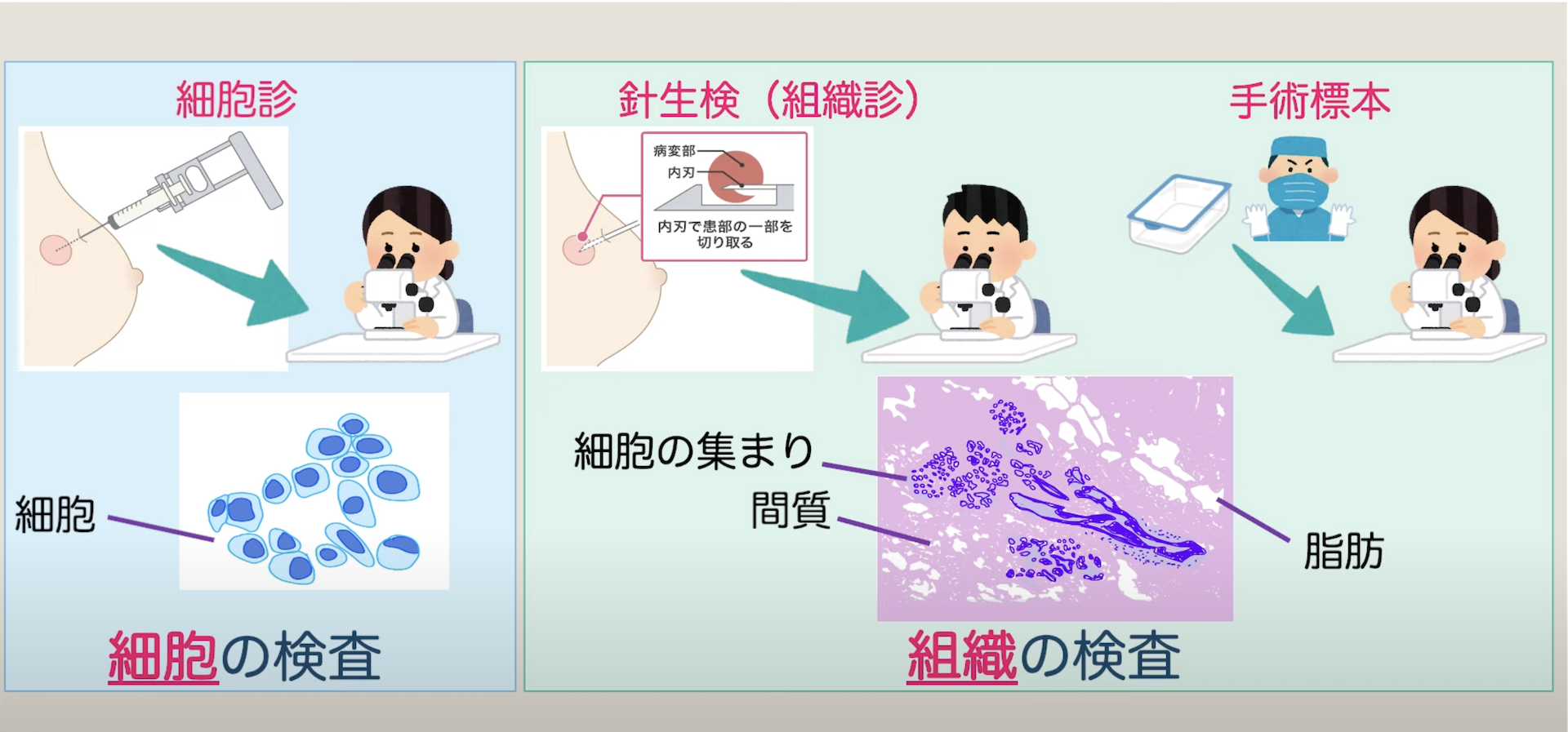 » 【病理前編】乳がん手術後の検査結果~ステージ・サブタイプ~|乳がん大事典|一般社団法人BC TUBE|複数人の乳腺科医による制作・監修
