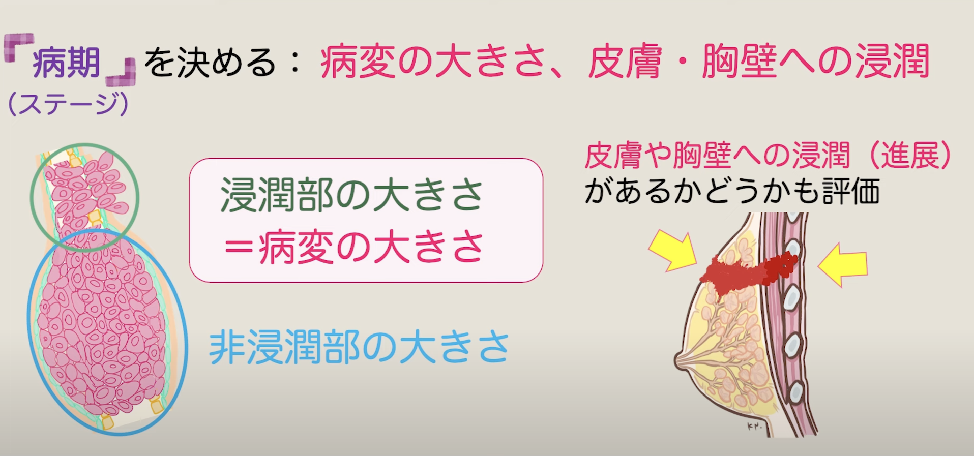 » 【病理前編】乳がん手術後の検査結果~ステージ・サブタイプ~|乳がん大事典|一般社団法人BC TUBE|複数人の乳腺科医による制作・監修