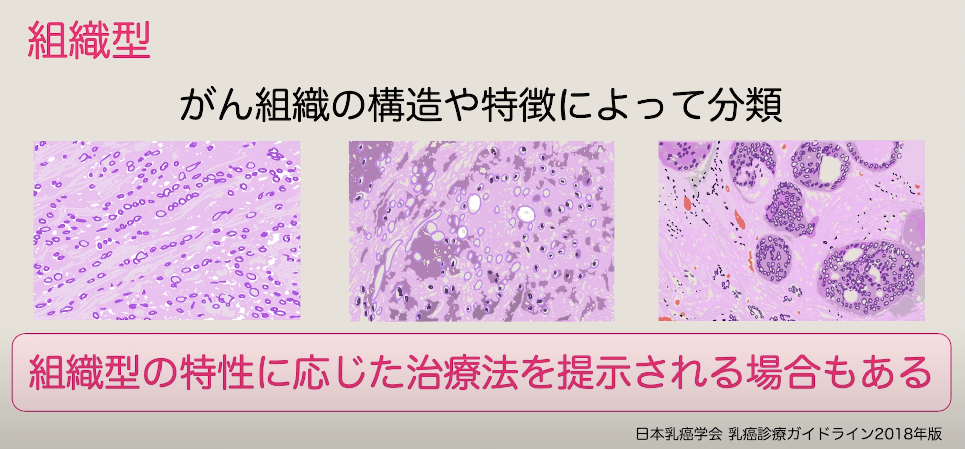 » 【病理後編】乳がん手術後の検査結果~組織型、グレード、Ki-67、脈管侵襲、断端~|乳がん大事典|一般社団法人BC TUBE|複数人の乳腺 ...