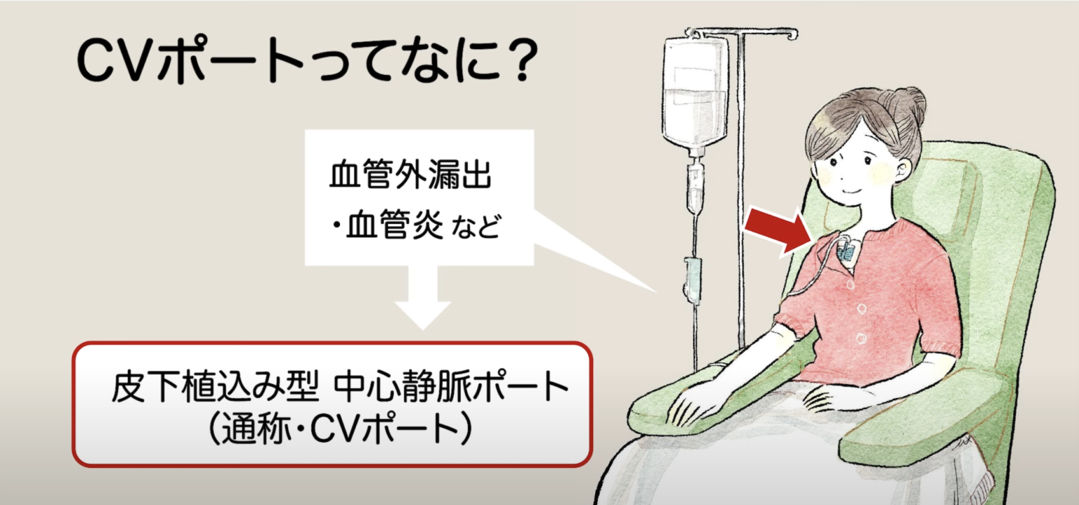 » CVポートって何？【皮下植込み型・中心静脈ポート】｜乳がん大事典｜一般社団法人BC TUBE…
