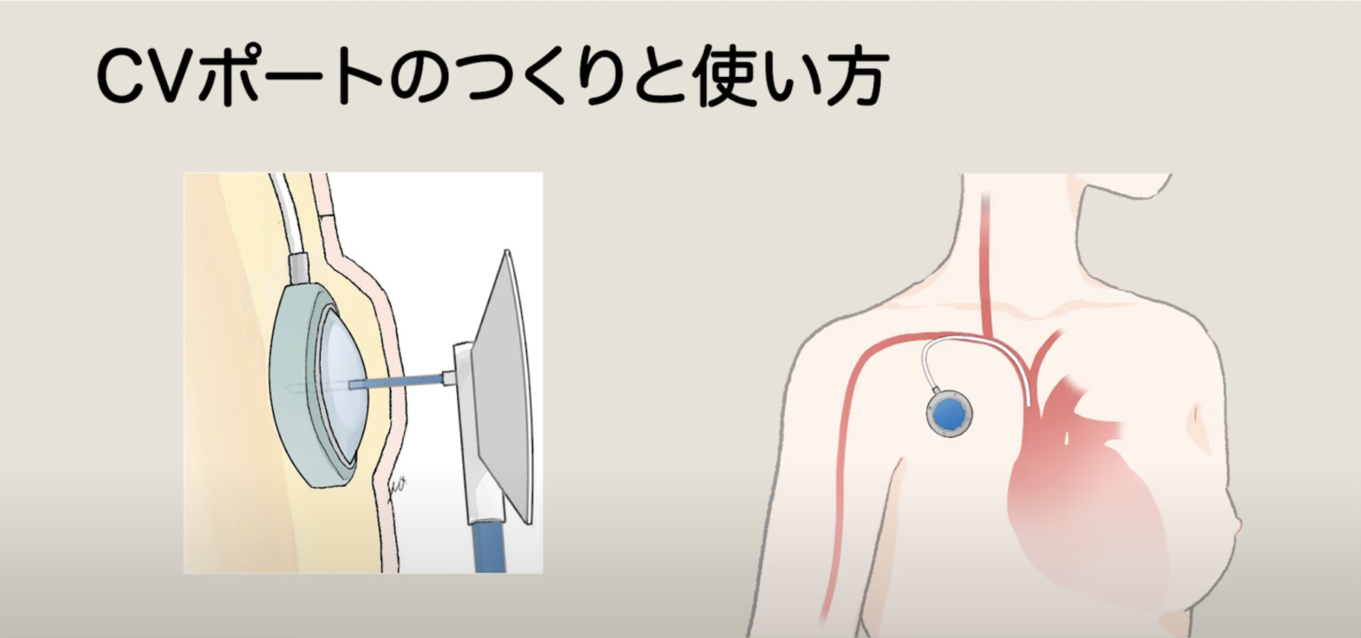 » CVポートって何？【皮下植込み型・中心静脈ポート】｜乳がん大事典｜一般社 …