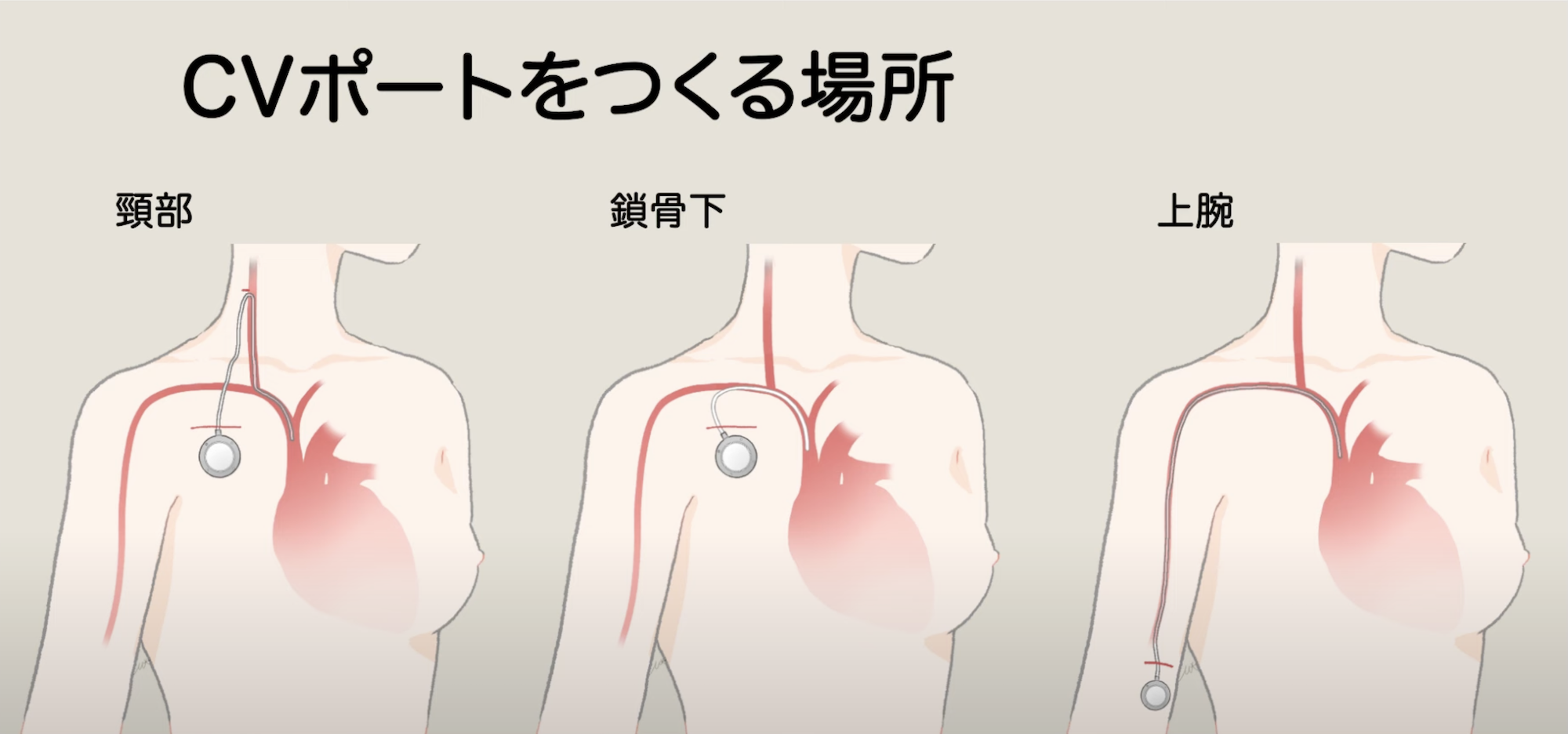 » CVポートって何？【皮下植込み型・中心静脈ポート】｜乳がん大事典｜一般社団法人BC TUBE｜複数人の乳腺科医によ …